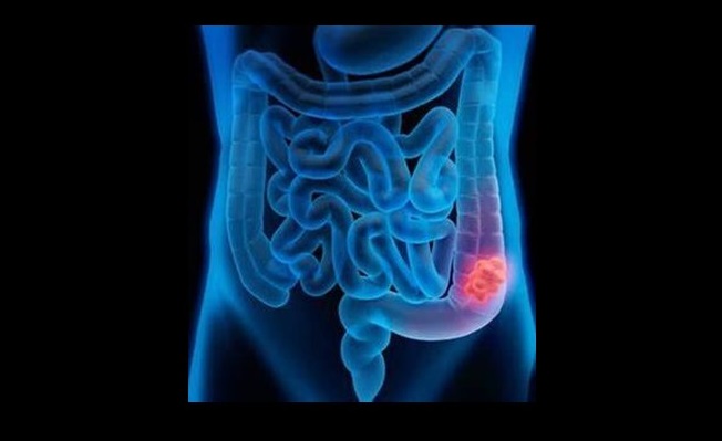 Image showing a cartoon representation of the commonest location of colon cancer in the human large bowel.